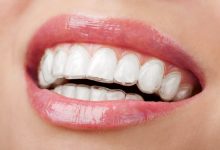 invisalign finance