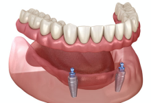 implant supported dentures