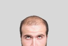 Hair transplant