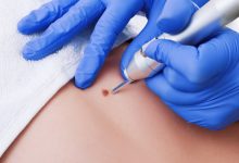 does urgent care remove skin tags