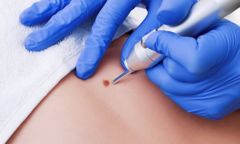 does urgent care remove skin tags