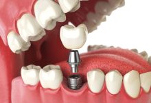 dental implant