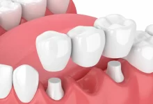 Dental Bridge