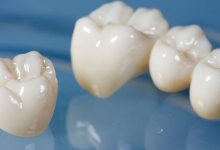 dental crown